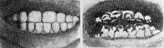 Dientes sanos y corroídos por el flúor